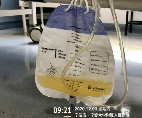 这种乳糜样腹水常漏诊,你见过吗?_腹腔镜