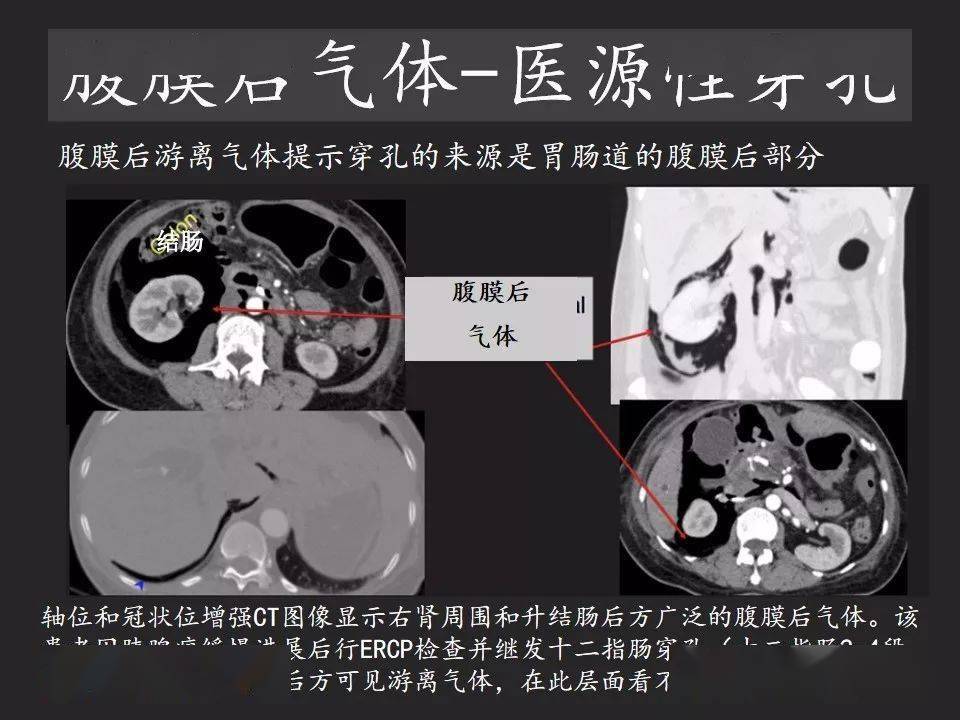 胃肠穿孔:气从哪里来?通过腹膜解剖确定穿孔部位