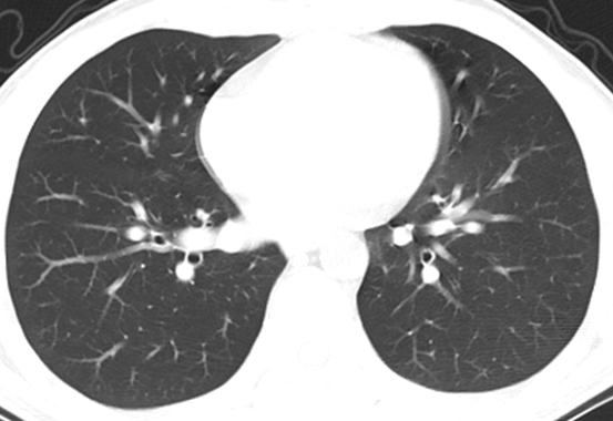 1,扫描层厚影响肺野透过度的因素1mm层厚1mm间距正常的肺野,肺纹理