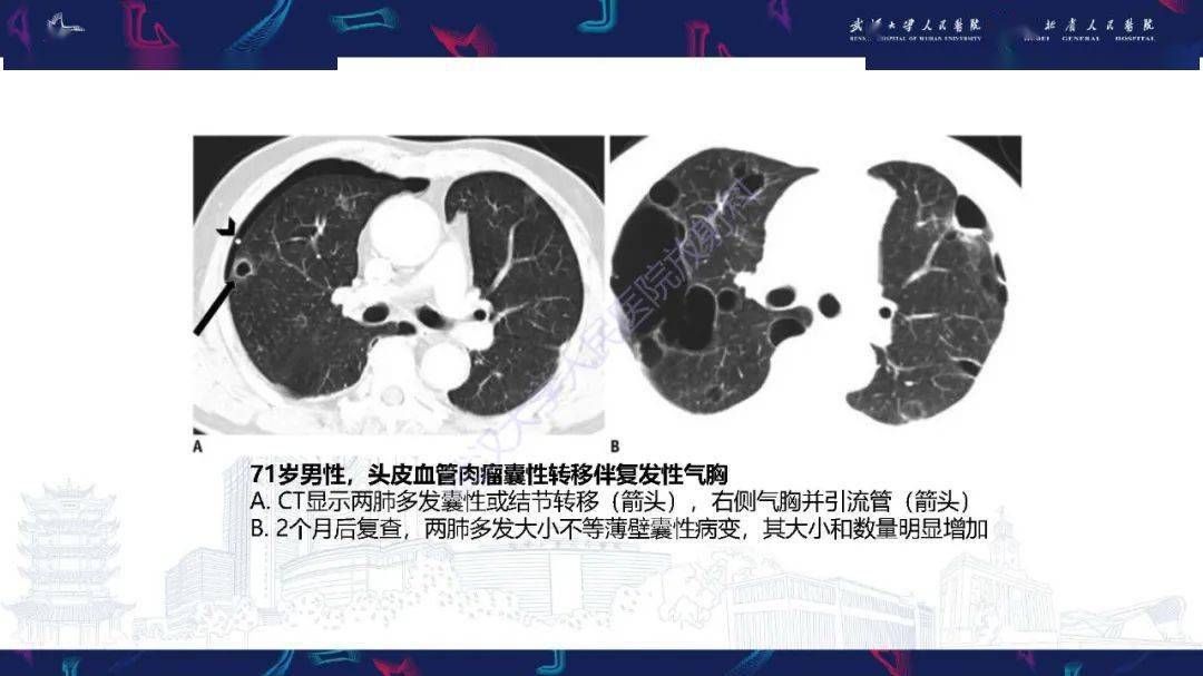 肺部囊性病变影像诊断