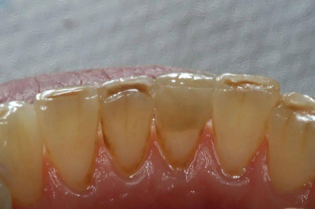 临床总结:  1,无论基牙为氟斑牙,四环素牙还是颜色正常,单颗牙的瓷