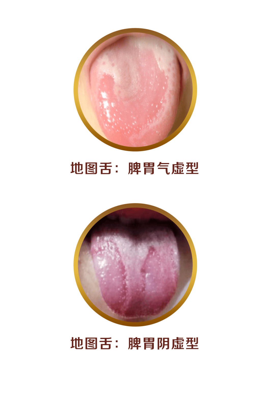 如果宝宝的舌苔部分掉落,剥落处光滑无苔,就是地图舌(花剥苔).