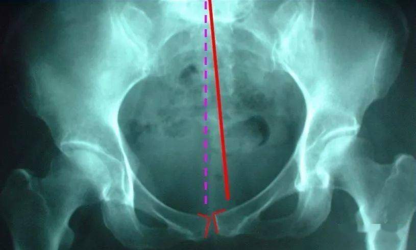 骶髂关节——骨盆中的一颗隐形炸弹_髂骨