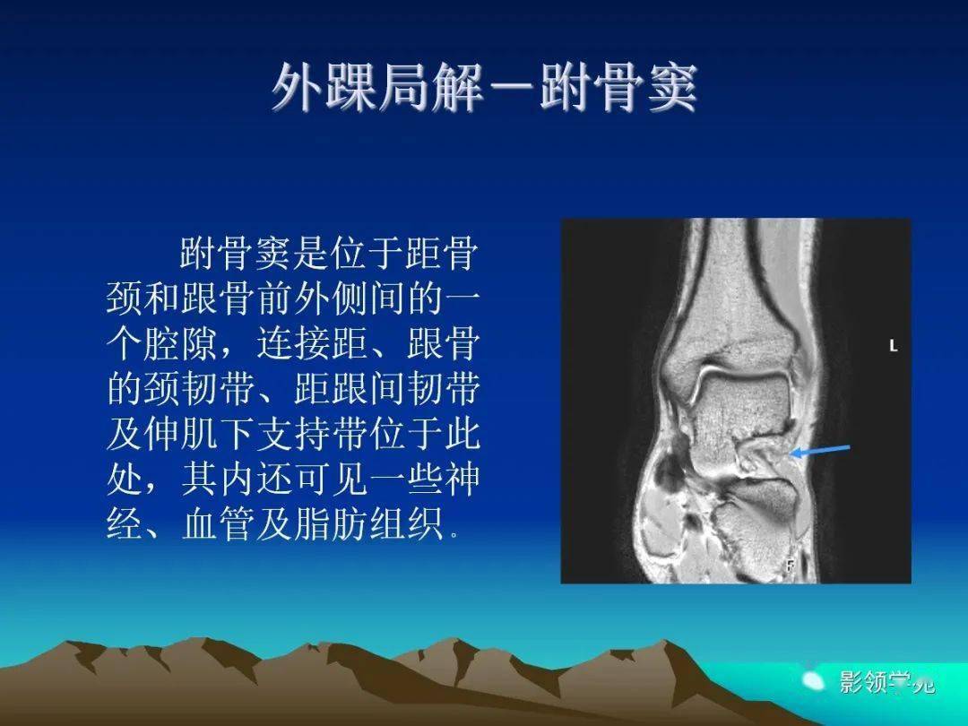 内外侧韧带实体解剖 ct,mri断层解剖及比较 mri检查条件及方法 踝关节