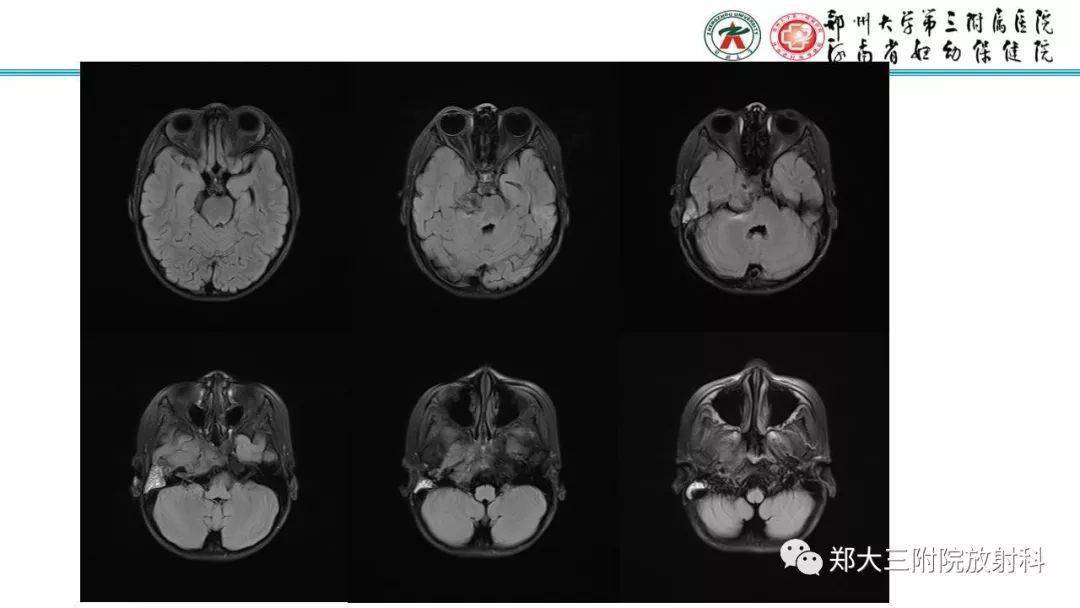 胚胎性横纹肌肉瘤病例分析