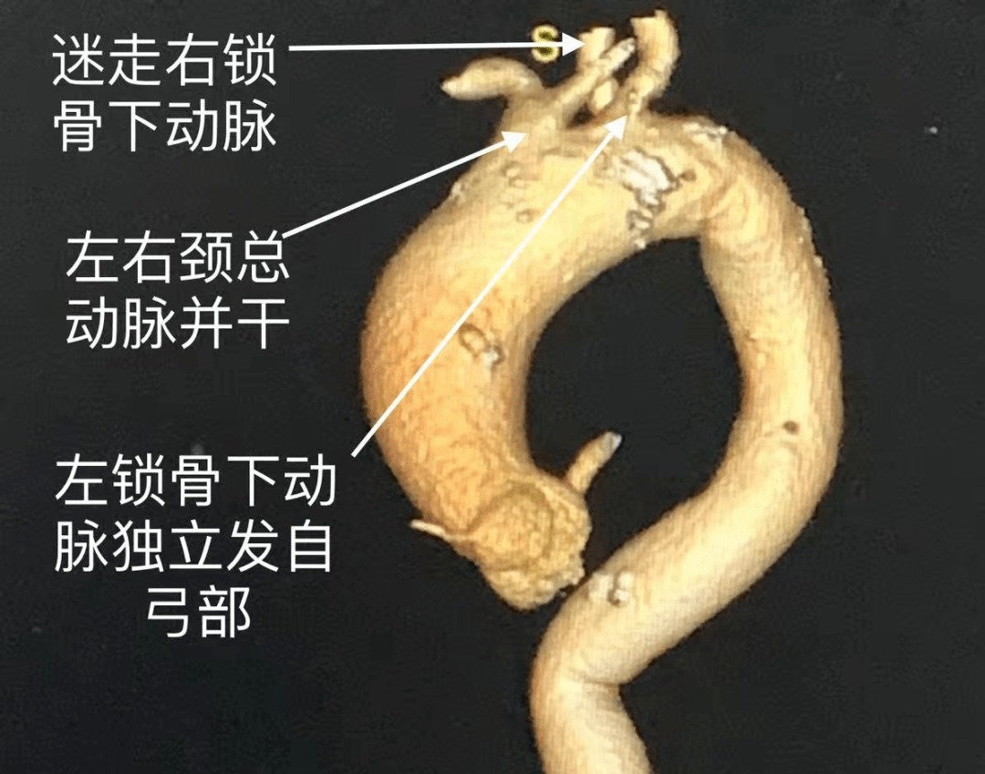 重医三院医疗动态我院成功完成一例a型主动脉夹层合并主动脉弓畸形