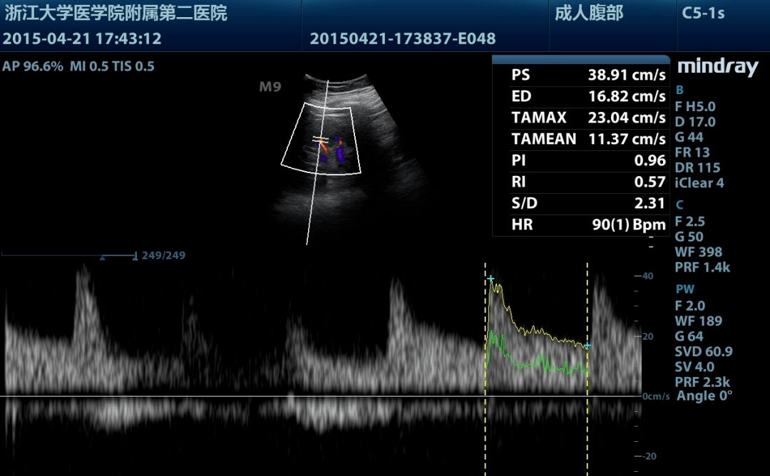 正常肾脏叶间动脉 ri 0.57