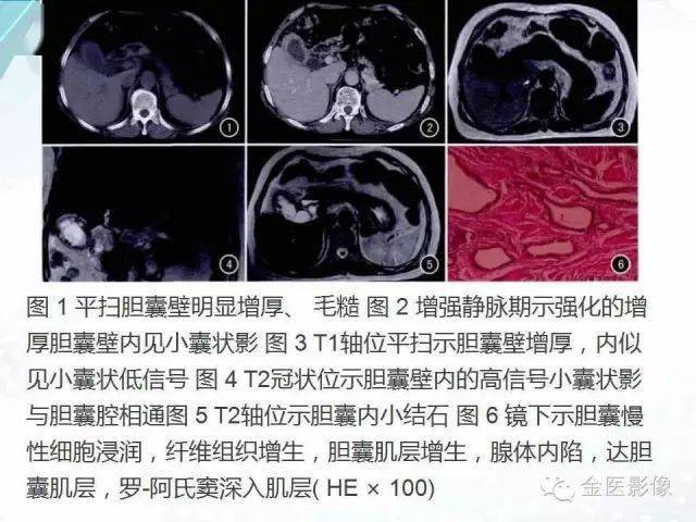 胆囊腺肌症影像表现及鉴别