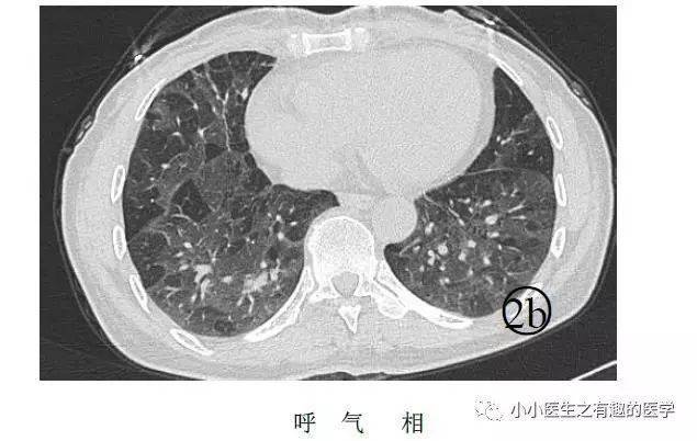 肺栓塞提高篇:ct平扫可发现,甚至诊断肺栓塞,看看国外