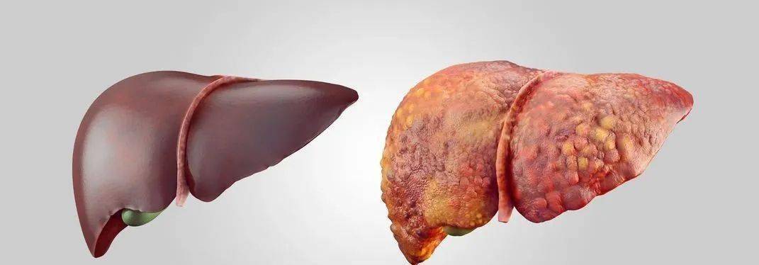 左图为正常的肝脏,右图为肝硬化