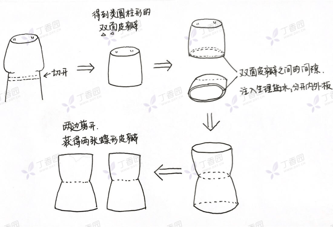 图源:自己画的 手术顺利结束,术后 12 天,患