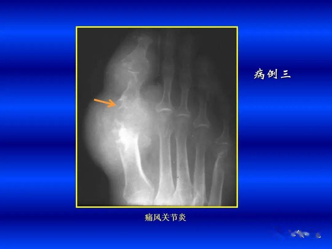 超全!各种关节炎的影像学表现