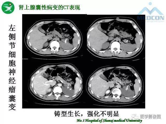 李健丁教授:肾上腺囊性病变的msct表现