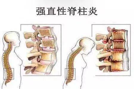 【正骨科普】疼了一年难入睡 竟是遗传父亲强直性脊柱炎