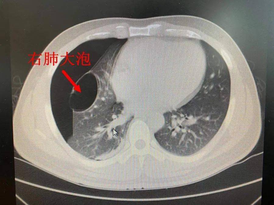 杭州市一总院胸外科助力我院外科36岁小伙反复自发性气胸微创手术解决