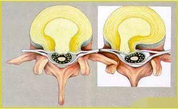腰椎间盘突出症