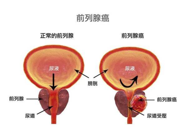 浙江一男子腰痛半月,一查竟是癌症晚期!这症状很多人忽视