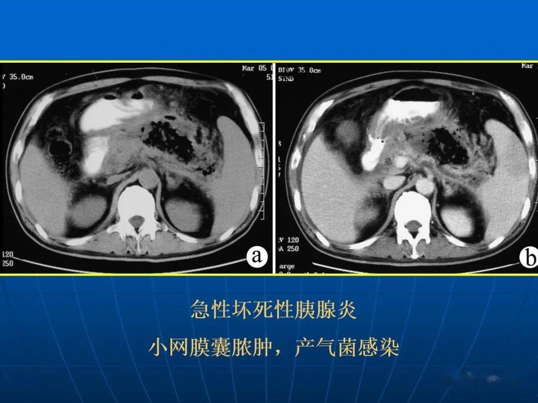 9种胰腺常见疾病的ct诊断