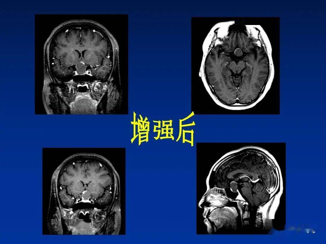 颅咽管瘤的影像诊断