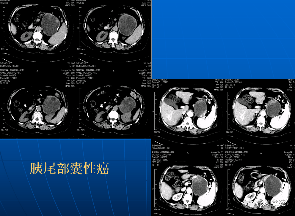 9种胰腺常见疾病的ct诊断