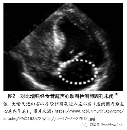 研究显示,通过注射激活盐水的对比增强tte(contrast tte,ctte),可提高