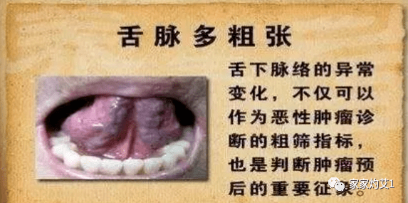 05倍,以肠癌最高;  裂纹舌中癌症患者为正常人的3.