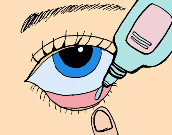 点眼药水/膏方法:用无菌棉签或清洁干净的手指拉开下眼睑,眼药水/膏