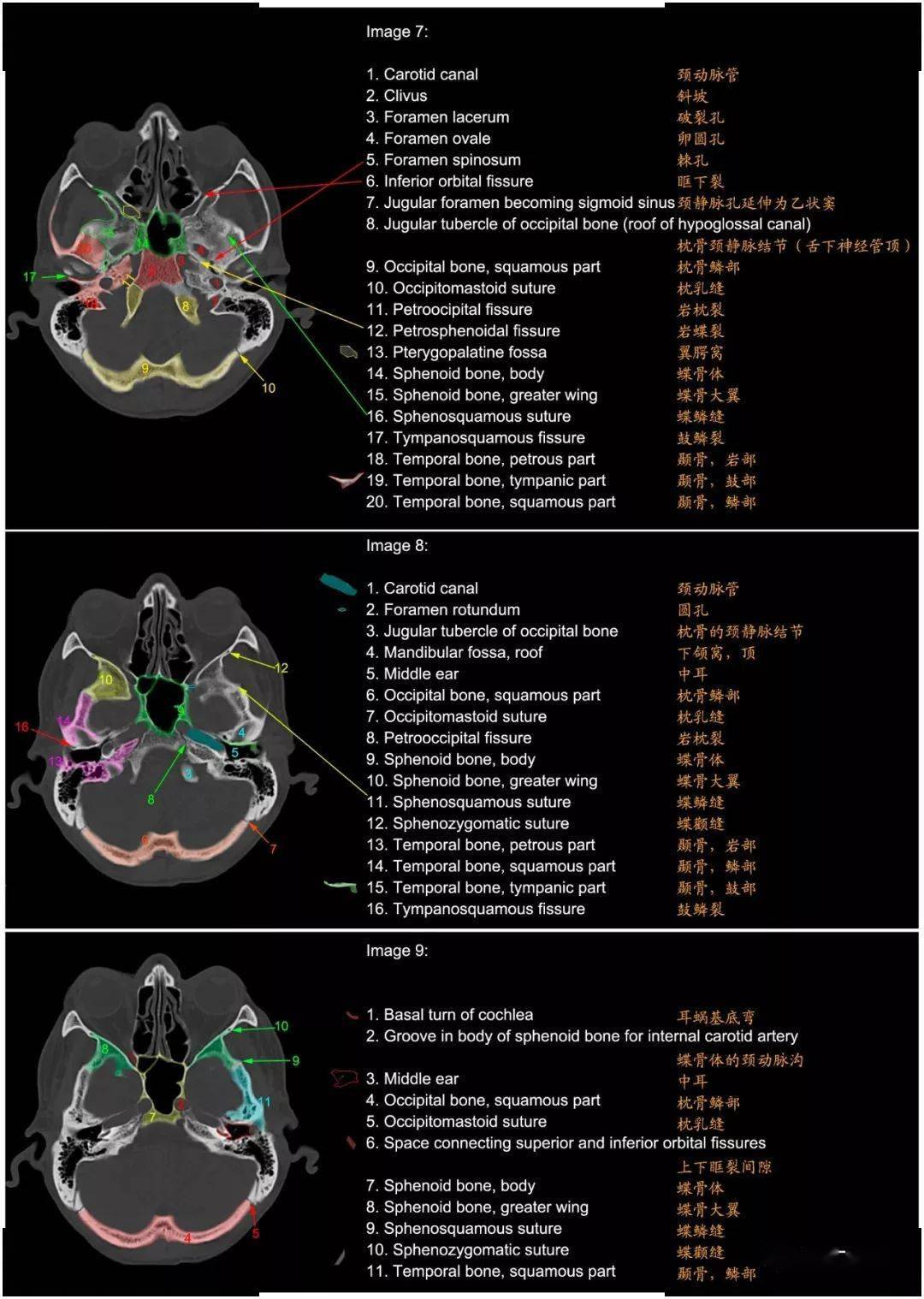 颅底ct高清断层解剖图谱,不能错过!(更新版)