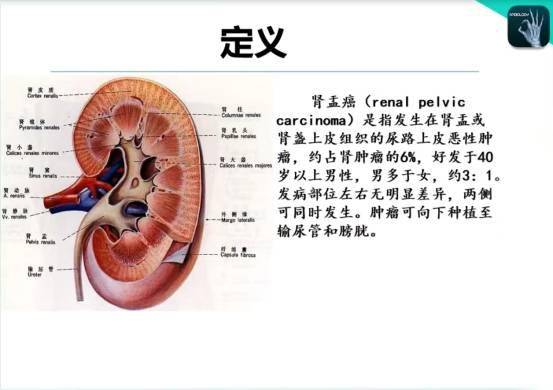 首先,我们来看一下肾盂癌的定义:肾盂癌是指发生在肾盂或肾盏上皮