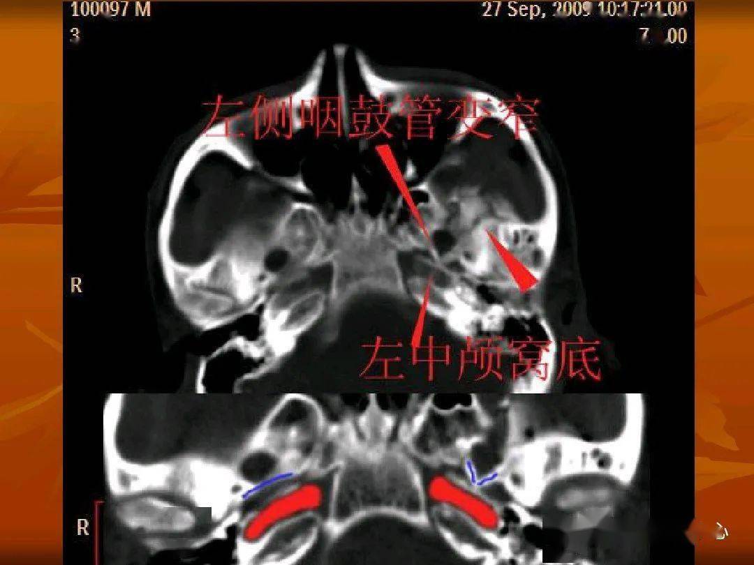 颅底ct高清图解 常见骨折部位图示