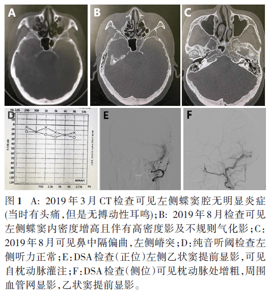 鼻窦ct提示鼻中隔左偏,左侧孤立行蝶窦炎(真菌性可能性大(图1 a-c.