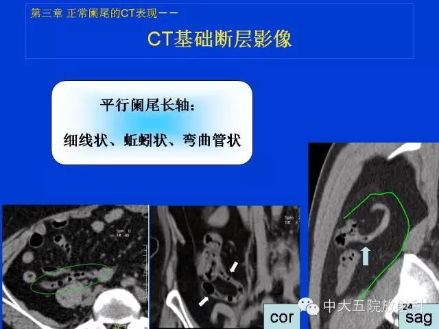 全面讲解正常阑尾和阑尾炎的ct表现