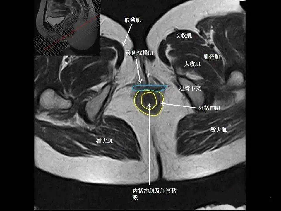 张8图带你熟悉盆底mri解剖