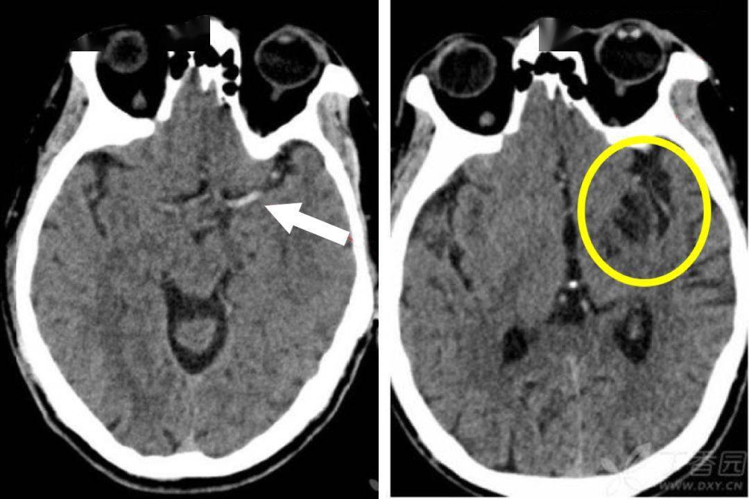 6 个病例学会「脑梗死」的 4 大 ct 征象