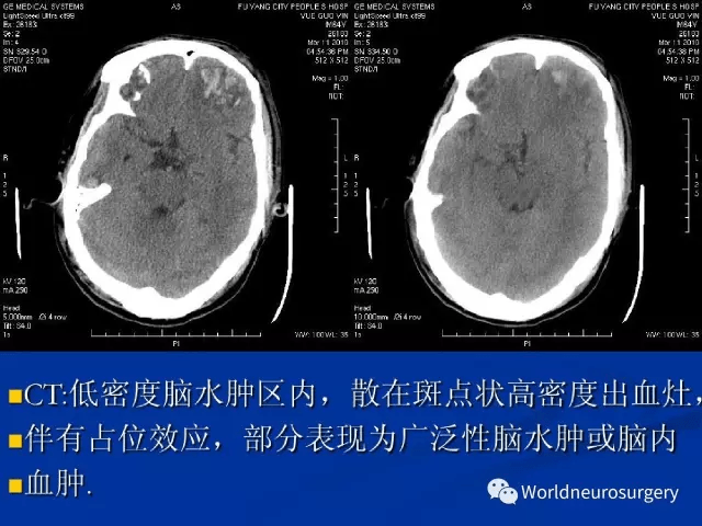 影像医生必须掌握的头颅ct解剖与常见出血梗死判读