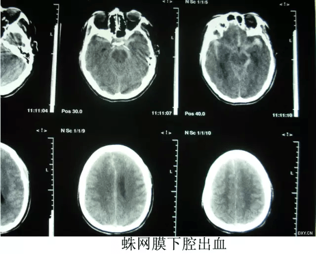 影像医生必须掌握的头颅ct解剖与常见出血梗死判读
