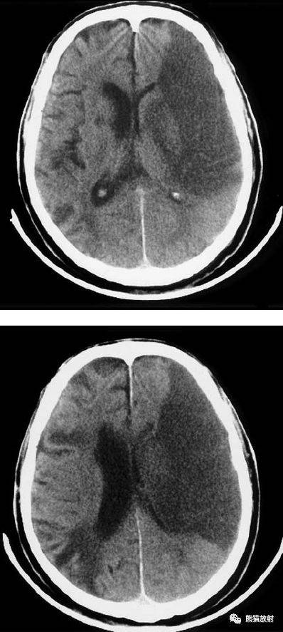 左侧大脑中动脉区完全梗死,对邻近的侧脑室产生占位效应;右侧可见其他