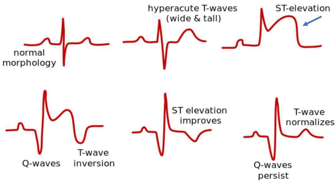 正常情况下,心电图上有三个主要的波群,p波,qrs波,t波,当然还可能