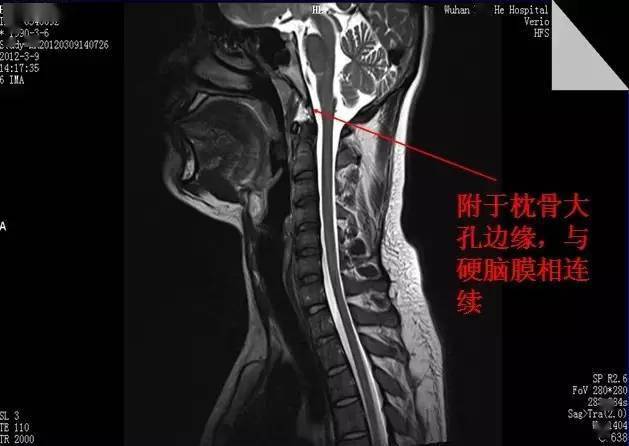 椎管解剖