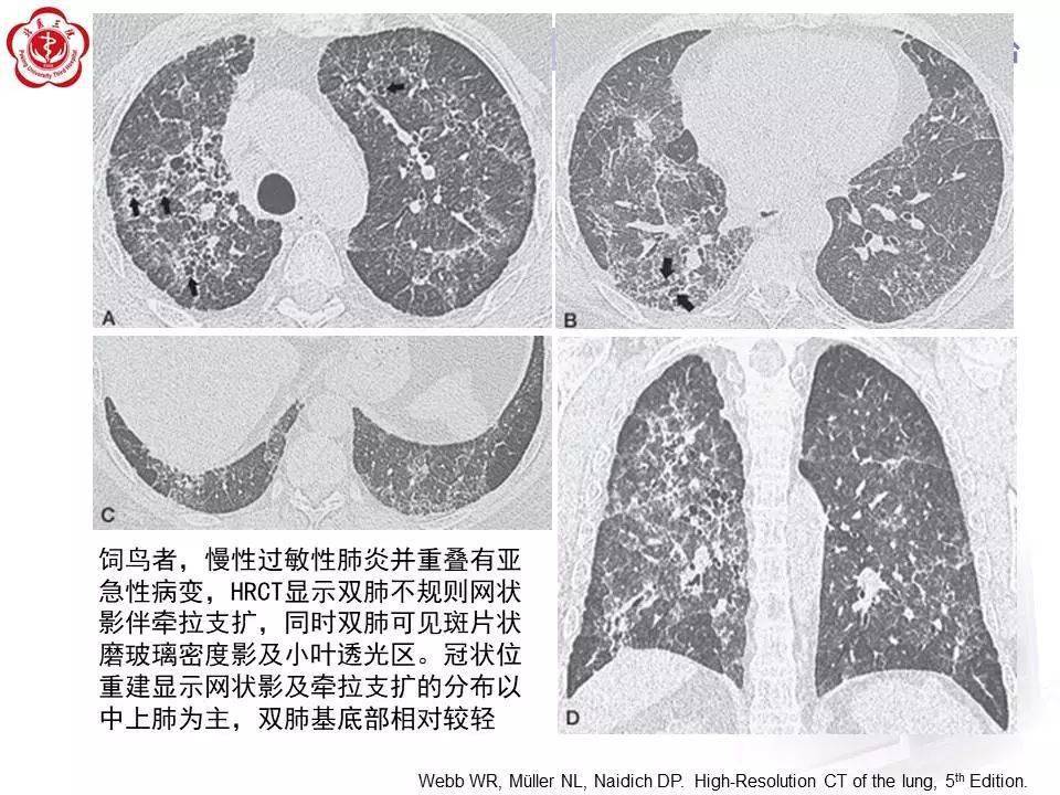 过敏性肺炎影像表现详细学习