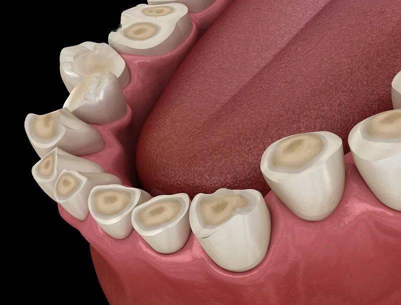 牙冠可能会受到磨损,牙齿也可能会发生松动    .