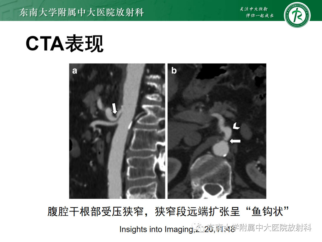 正中弓状韧带压迫综合征mals