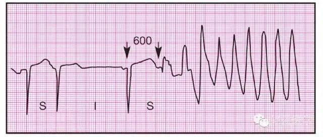 扭转型室性心动过速
