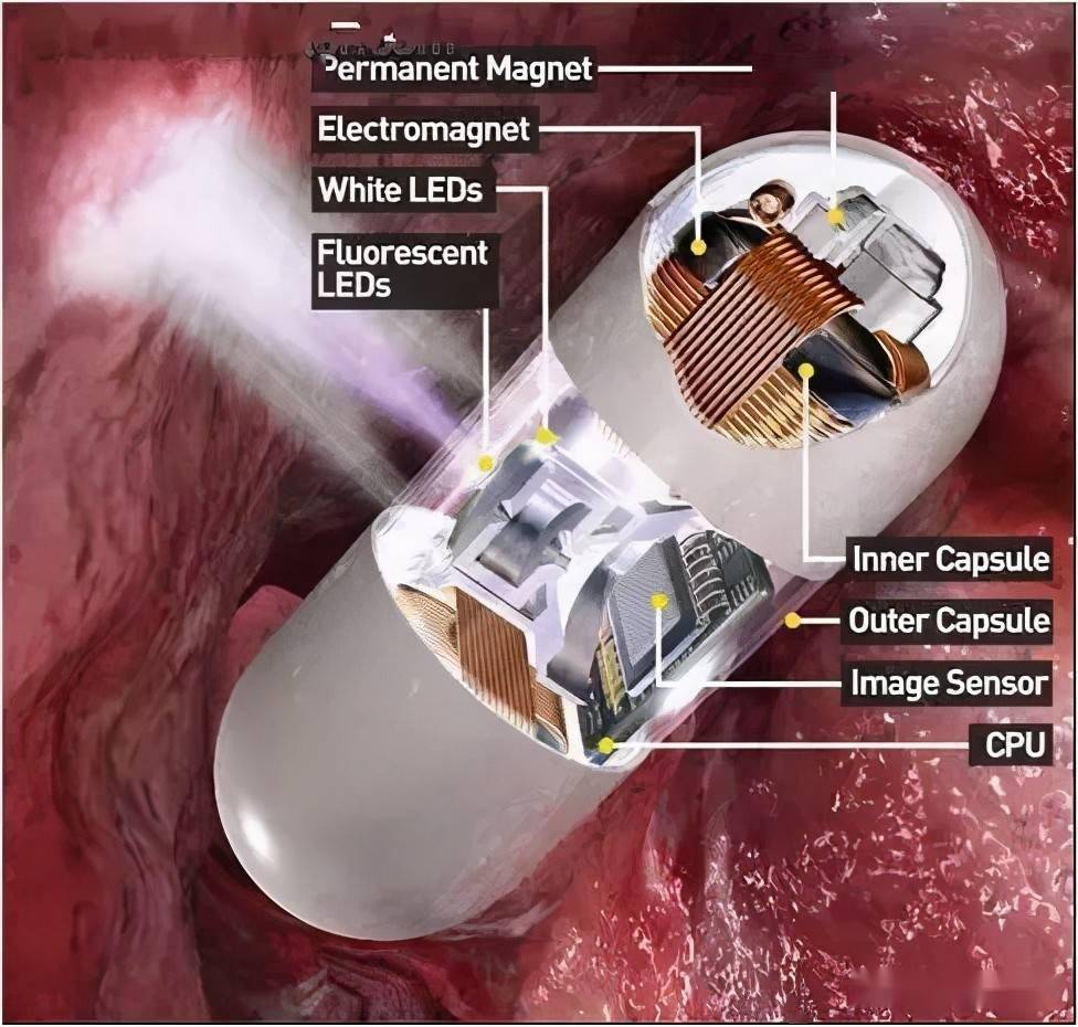 胶囊胃镜让胃镜检查不再"畏敬"