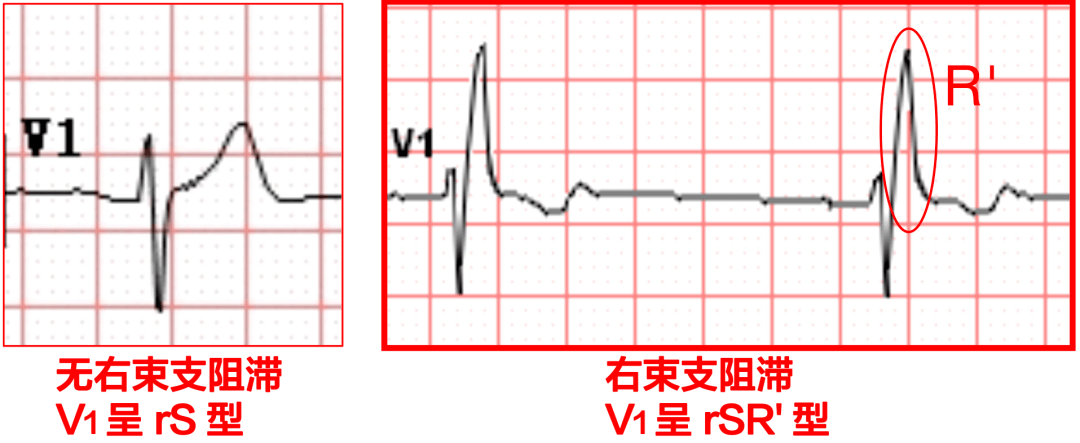 有关右束支阻滞的4问4答附典型心电图基础篇