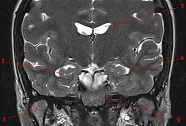 鞍区,垂体磁共振(mri)解剖——冠状面