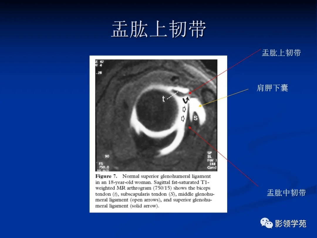 分别附着于前盂唇和后盂唇的边缘,呈v形附着于肱骨解剖颈