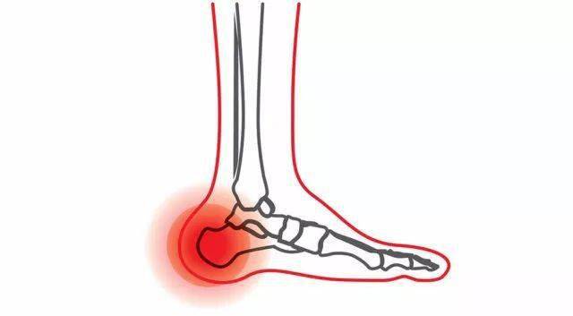 【中医·强直性脊柱炎】强直性脊柱炎脚底疼痛是什么回事?