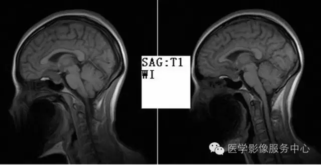 颅脑ct容易漏诊的这个部位