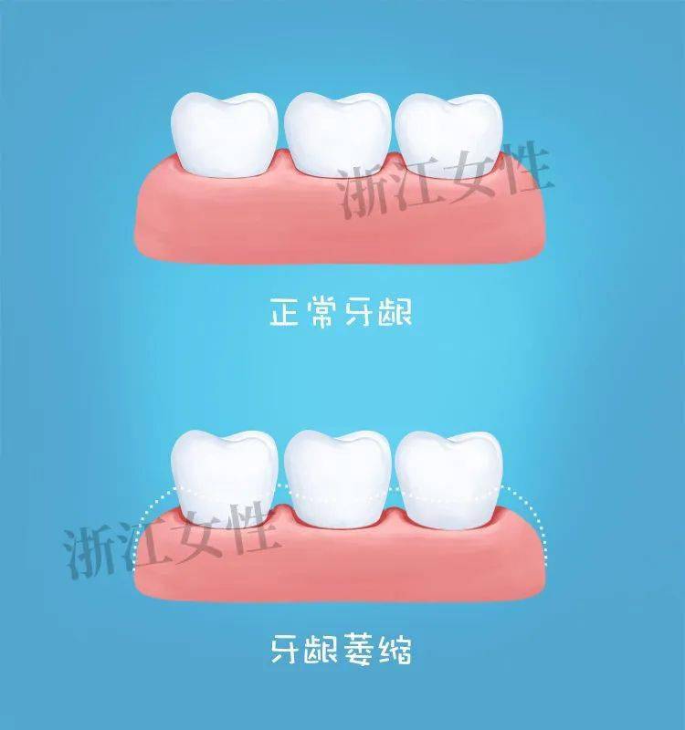 其实,这是牙龈萎缩的症状,牙根部位的牙龈退缩,将牙根暴露出来,牙齿才